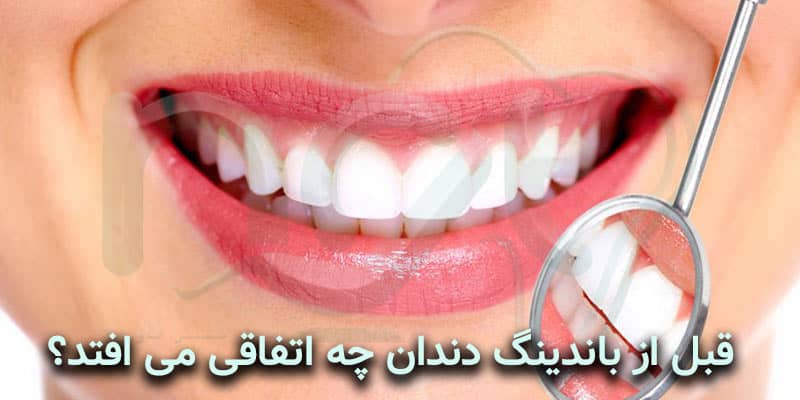 قبل از باندینگ دندان چه اتفاقی می افتد؟